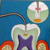 ���[�U�[����p�������V���T�m�@��@DIAGNOdent�i�J�{�@�_�C�A�O�m�f���g�j