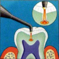 ���[�U�[����p�������V���T�m�@��@DIAGNOdent�i�J�{�@�_�C�A�O�m�f���g�j